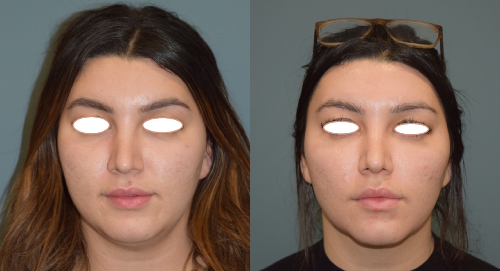 Surgical Facial Contouring: Buccal Fat Removal, Cheek Augmentation and Neck Liposuction
