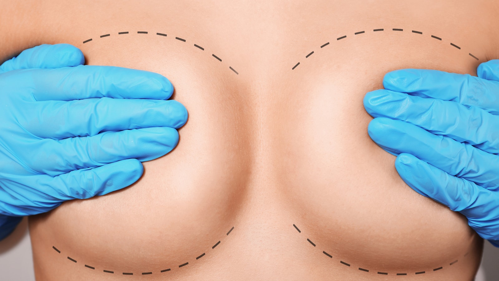Flash Recovery Breast Augmentation