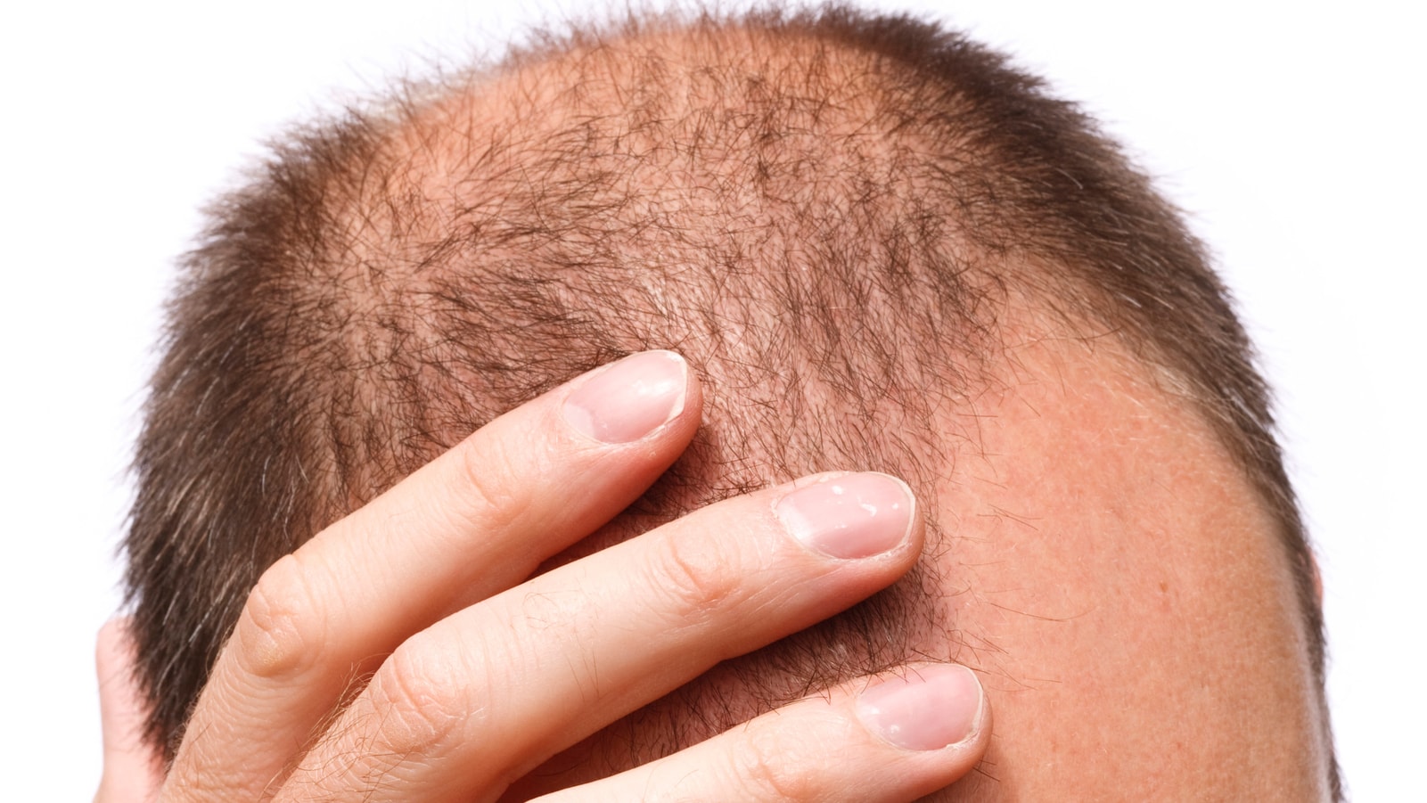 Rogaine for Male Pattern Baldness