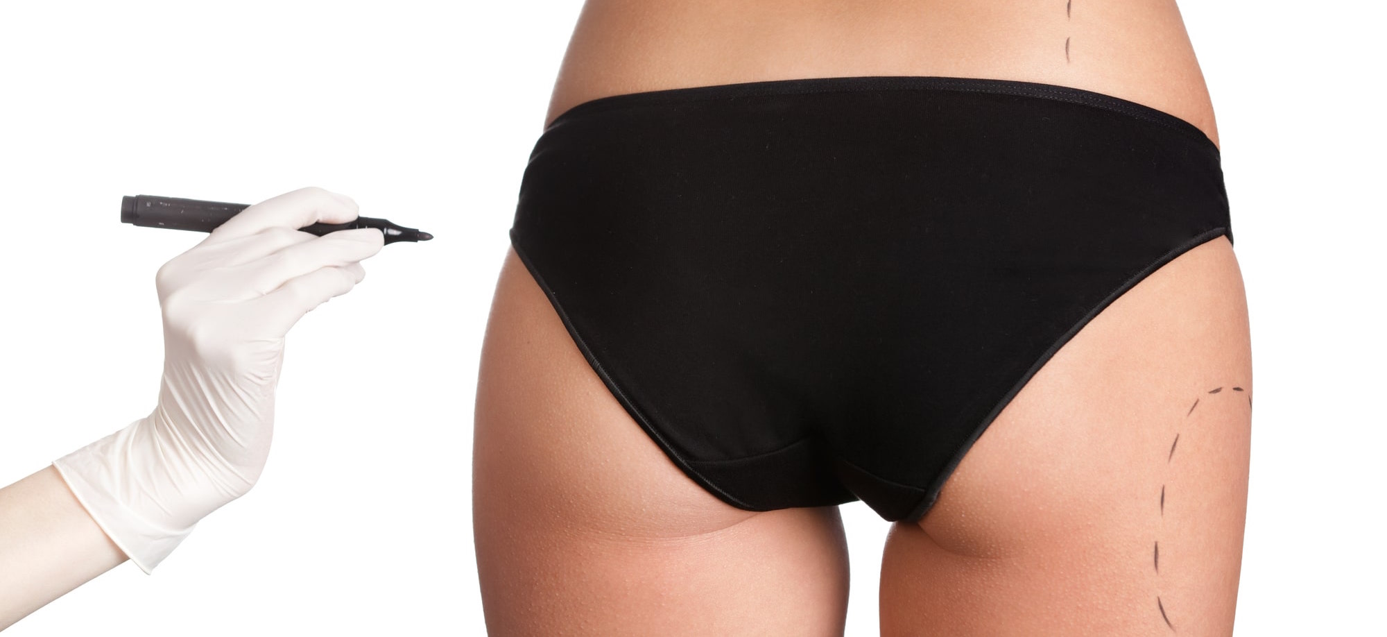 Discover the nonsurgical butt augmentation choices for BBL