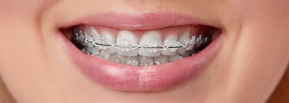 Clear aligners or braces which should you choose