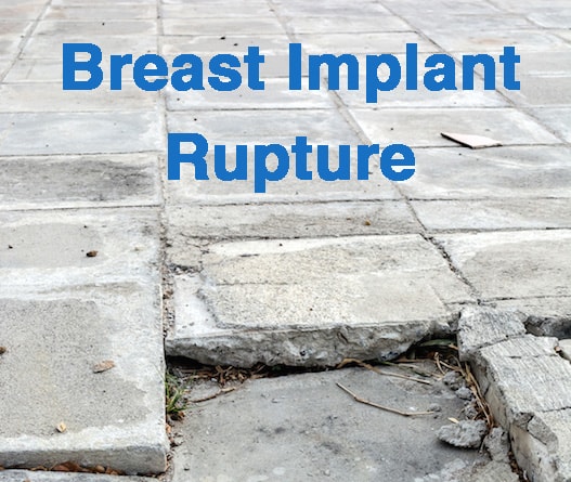 Brest Implant Rupture Lawsuite
