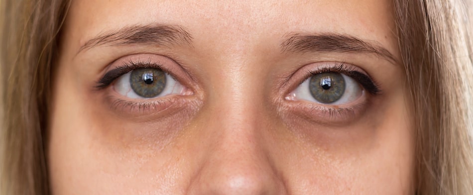Dark Circles Under the Eyes - How to Get Rid of Them