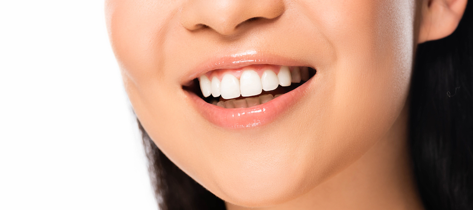 Dental Veneers - Massive Market Growth for Cosmetic Teeth Treatment