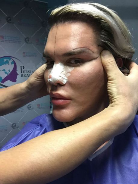 “Human Ken Doll” Celebrates Birthday with More Plastic Surgery