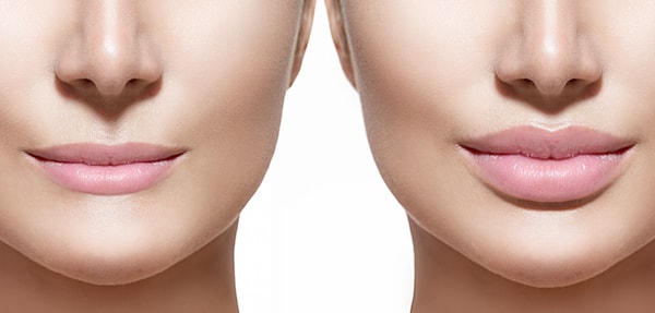 Who is an ideal candidate for lip augmentation?