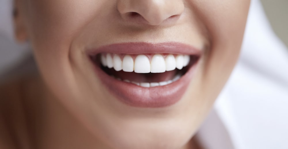 Dental Veneers to Improve Teeth Appearance