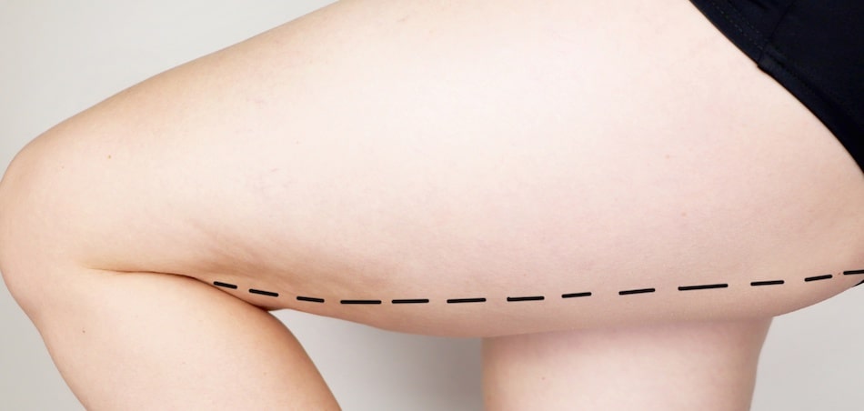 Is a Thigh Lift Worth the Surgery?