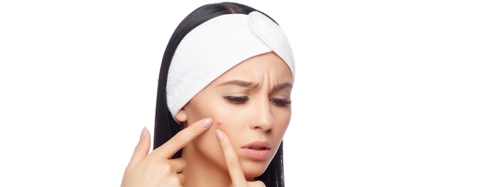 Acne treatment can be done with laser