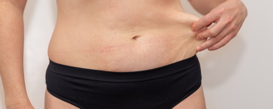 How to minimize the appearance of liposuction scars