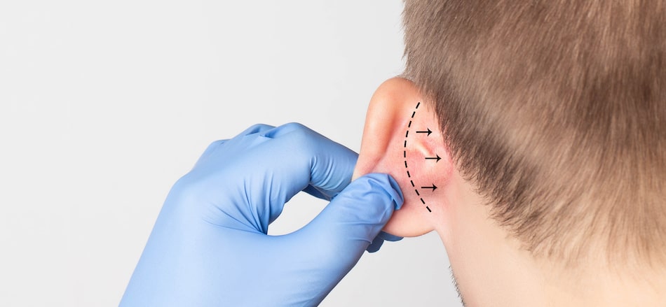 Otoplasty Improved - New Ear Reconstruction Method