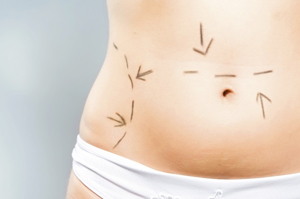 Top Cosmetic Surgery Treatments to Tighten the Tummy