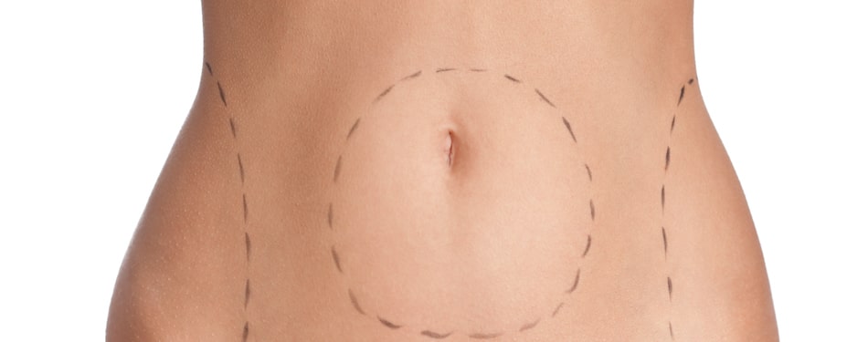 The benefits of liposuction and tummy tuck surgery combined