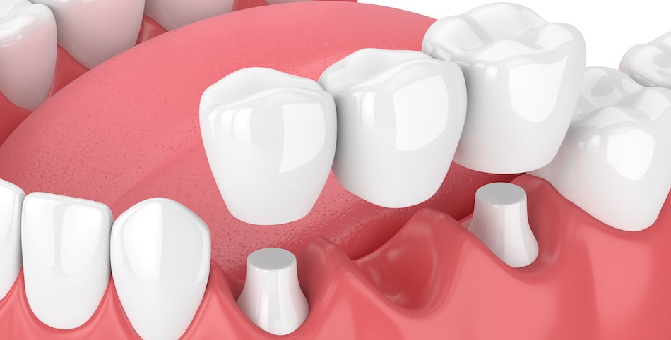 Dental Bridge - What is It and How Does it Benefit the Mouth?