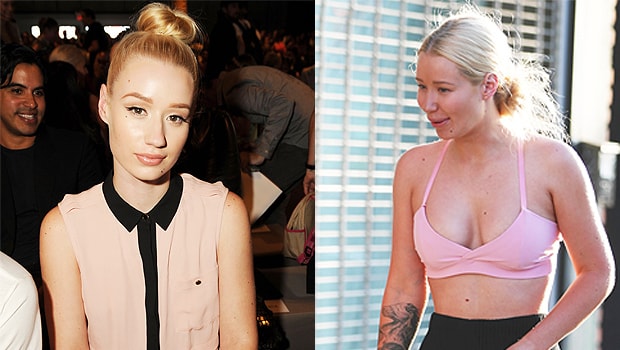 Iggy Azalea opens up about the plastic surgery she did