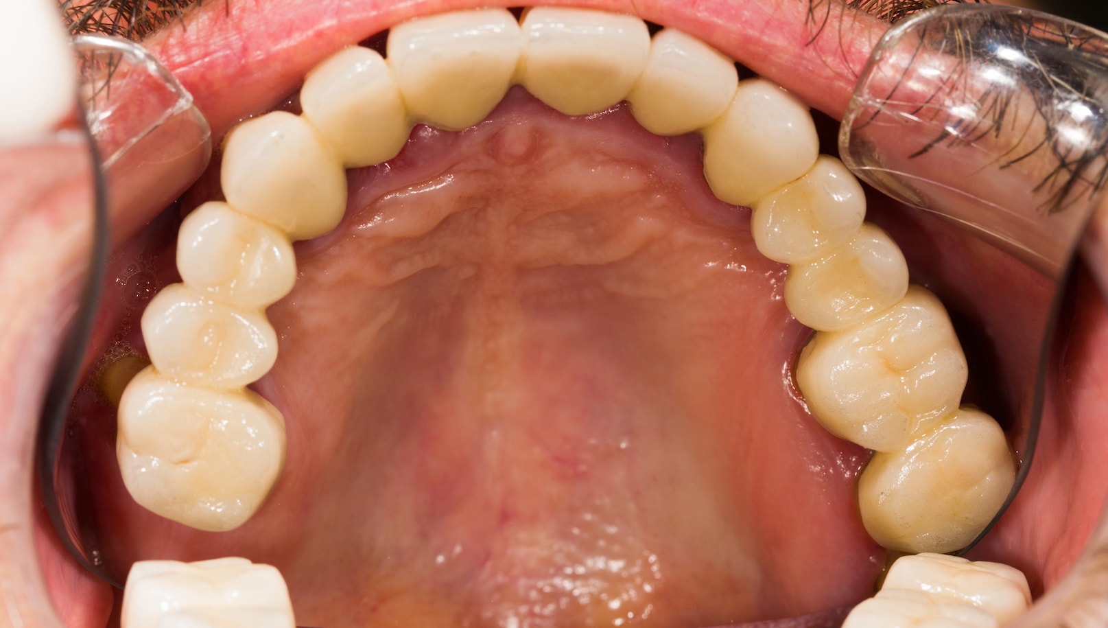 Dental Onlays and Crowns