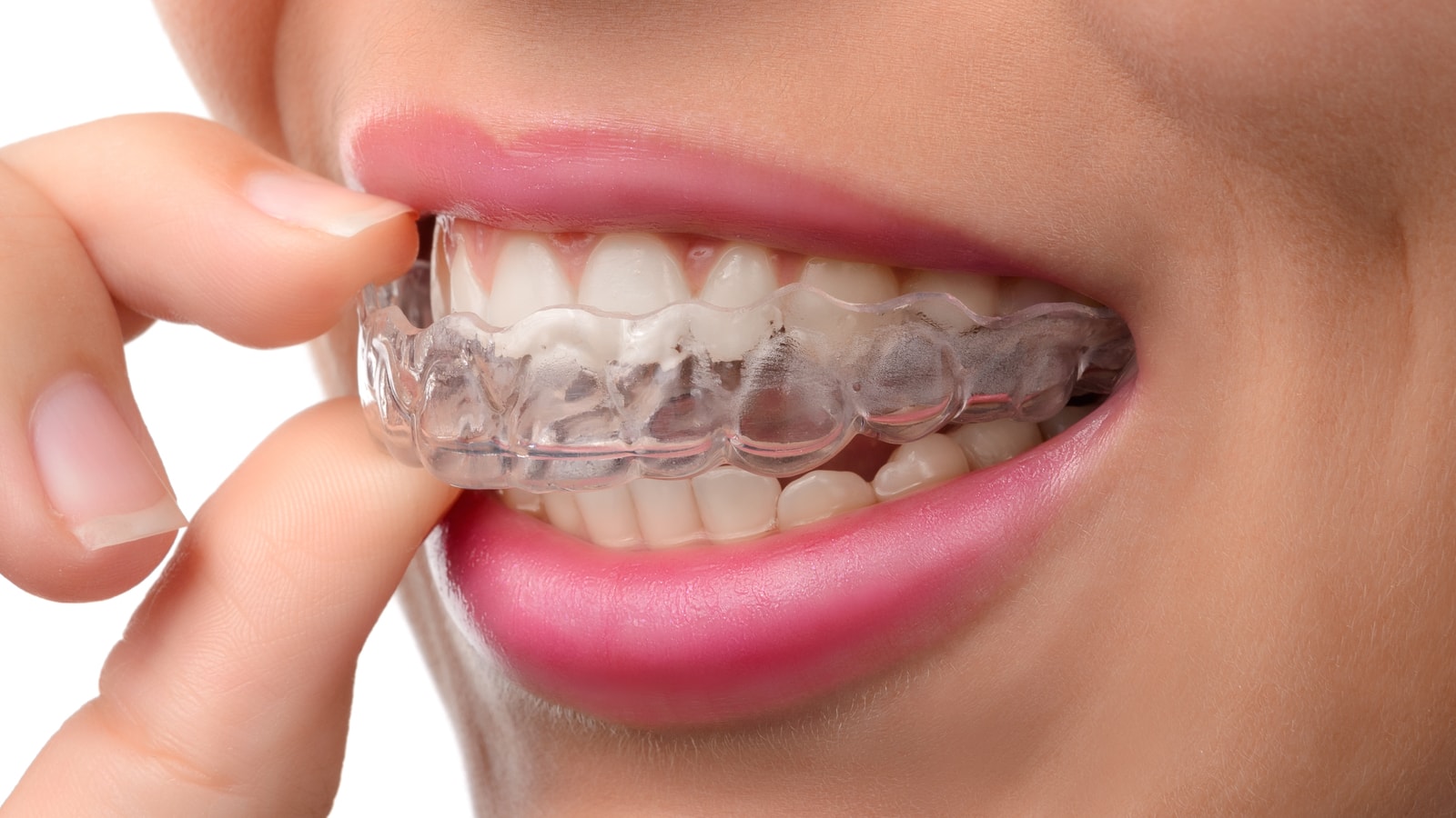 Invisalign: An Alternative to Braces