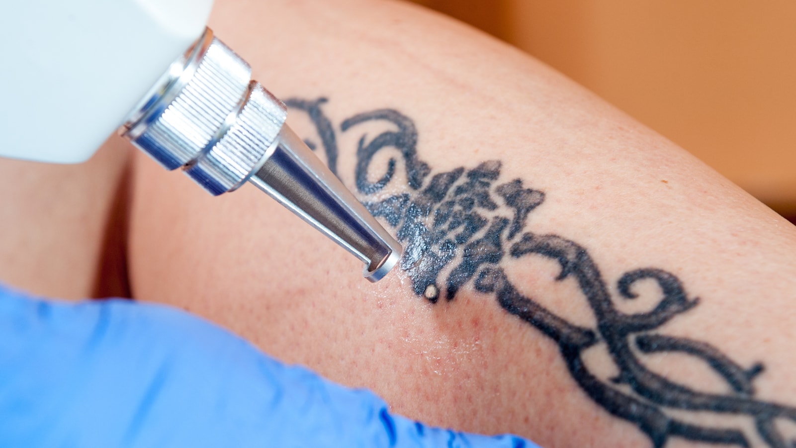 Laser Tattoo Removal