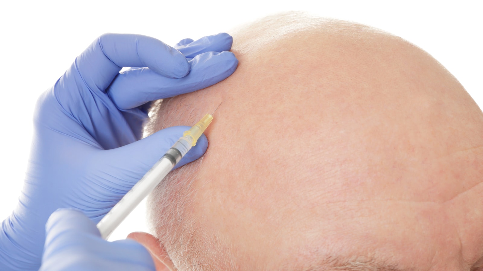 PRP for Hair Restoration