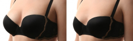 Breast Reduction - Procedure Info Revealed