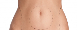 Liposuction and Tummy Tuck - Why They are Performed Together