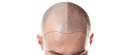 Scalp Micropigmentation as a Response to Hair Loss