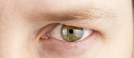 Droopy Eyelid - Improve Your Vision with Plastic Surgery