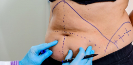 Tummy Tuck – How is it Performed?