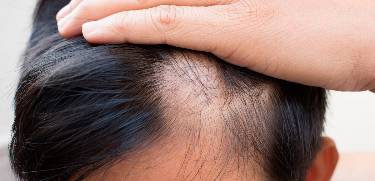 androgenic alopecia