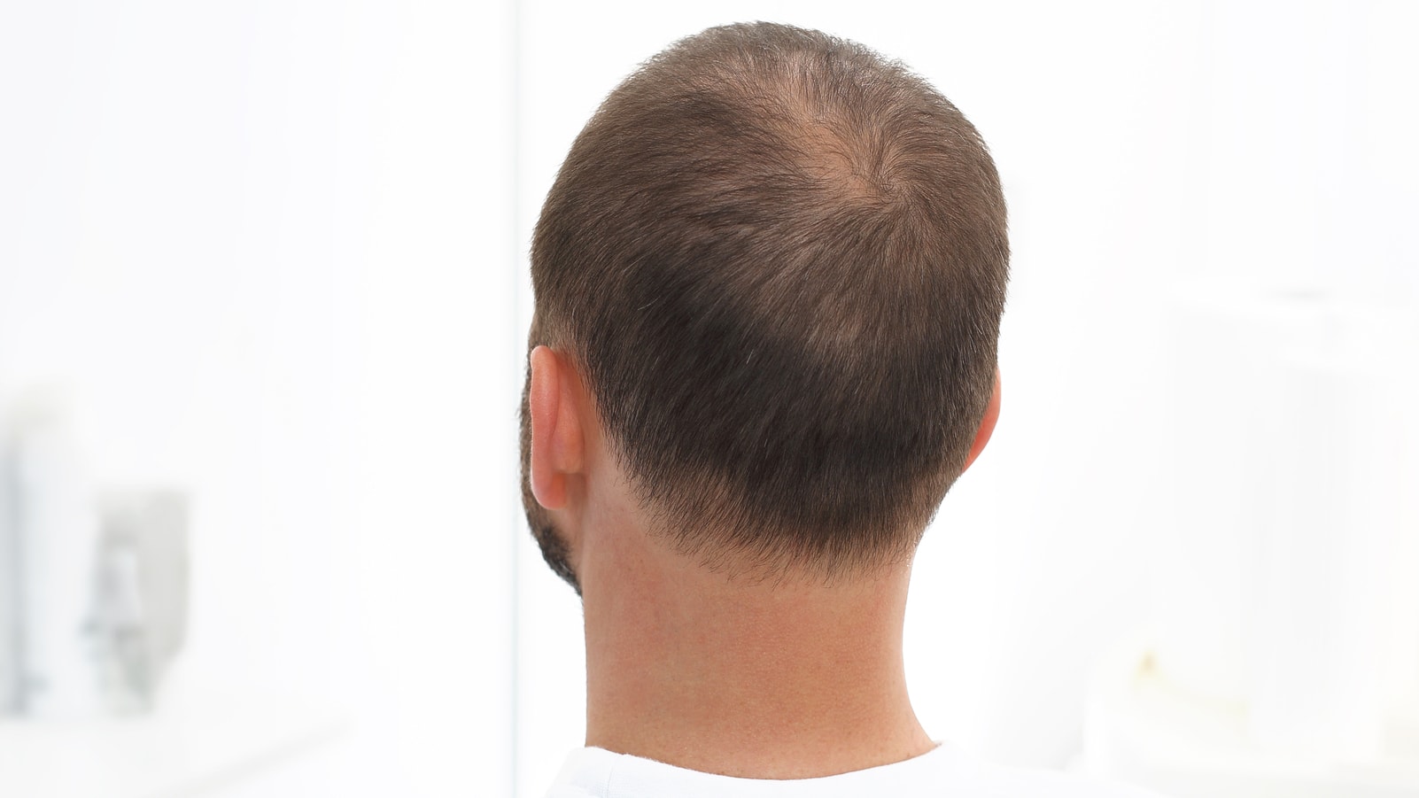 Alopecia Areata