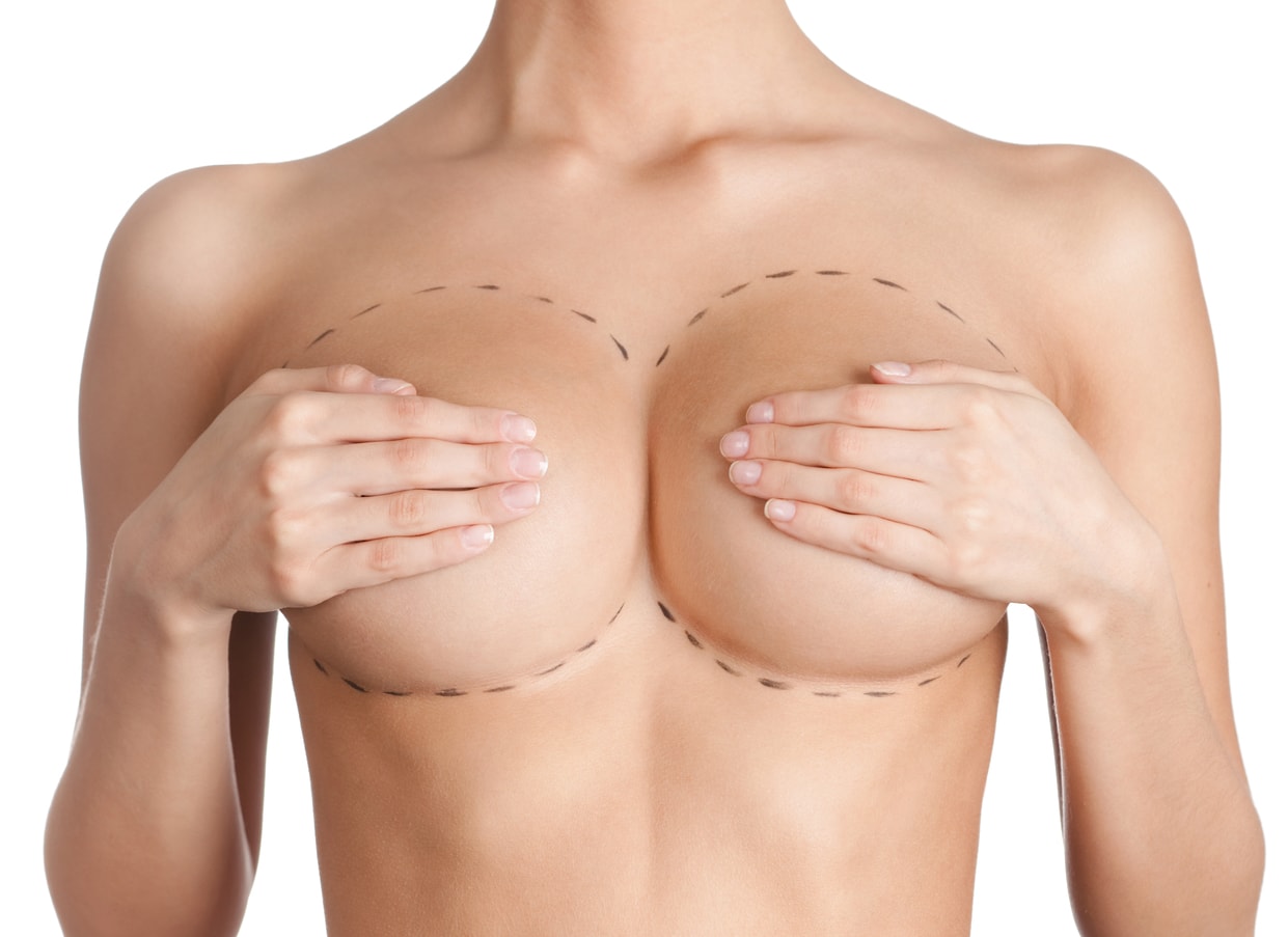 Anchor vs. Lollipop Breast Reduction