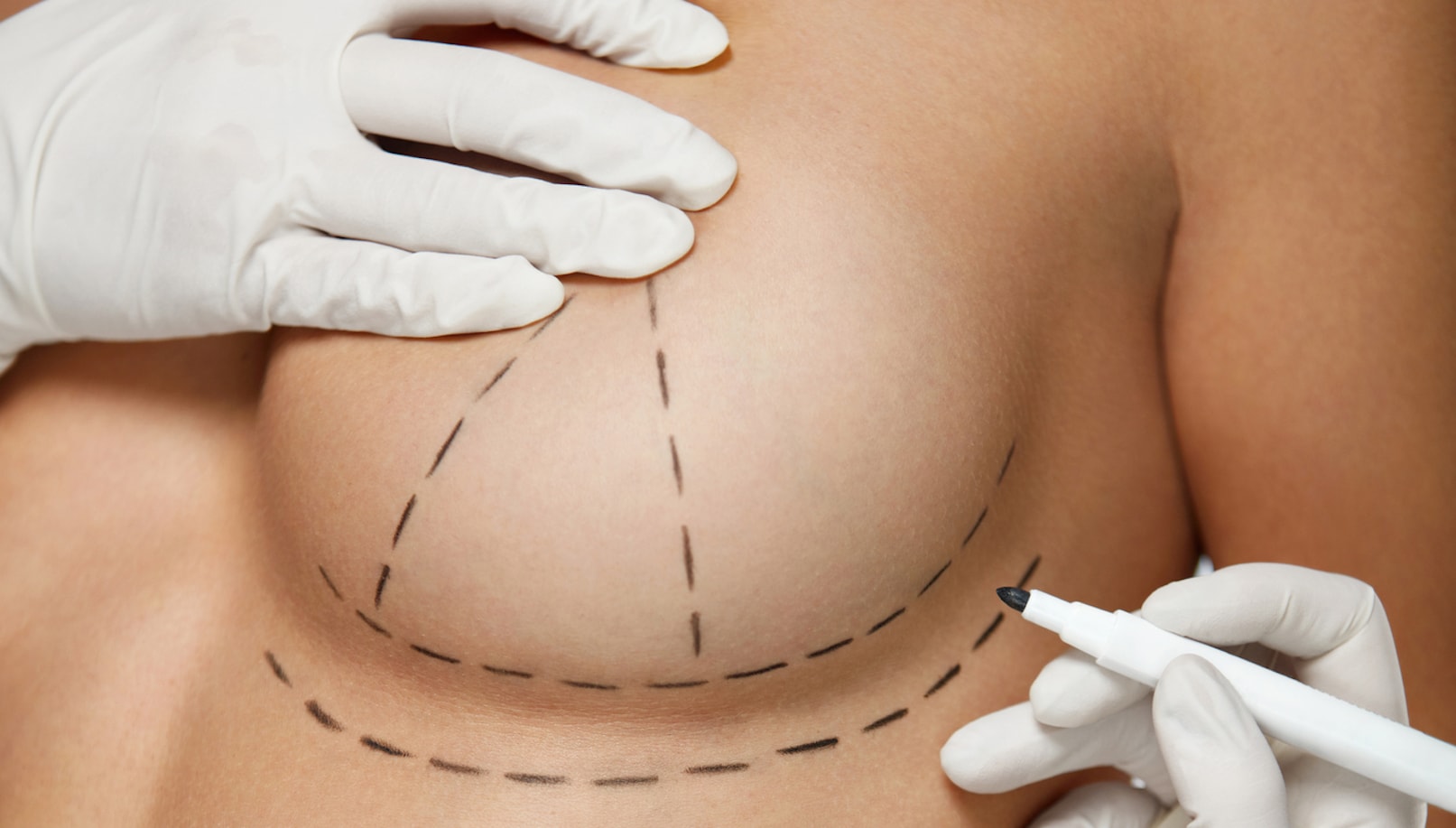 Breast Augmentation