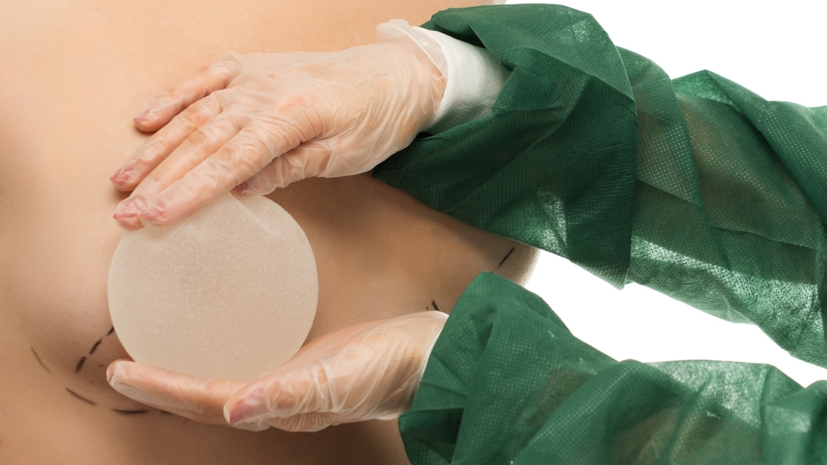 Breast Implant Placement