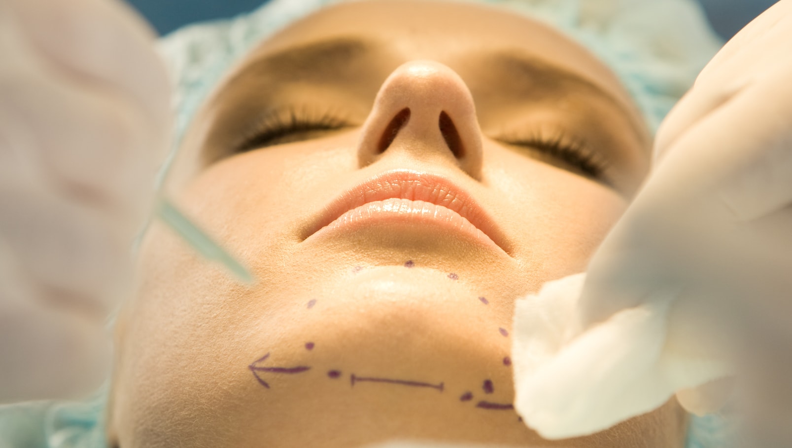 Chin Liposuction