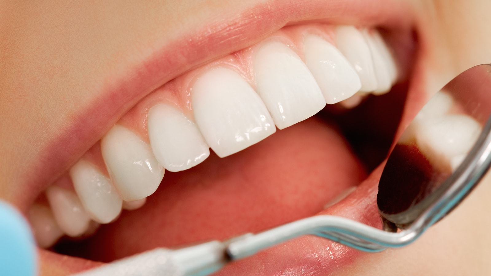 Cosmetic Tooth Bonding - Riverside Dental