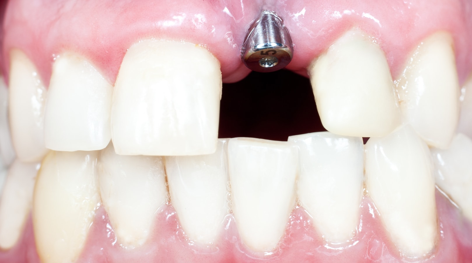 Dental Implants