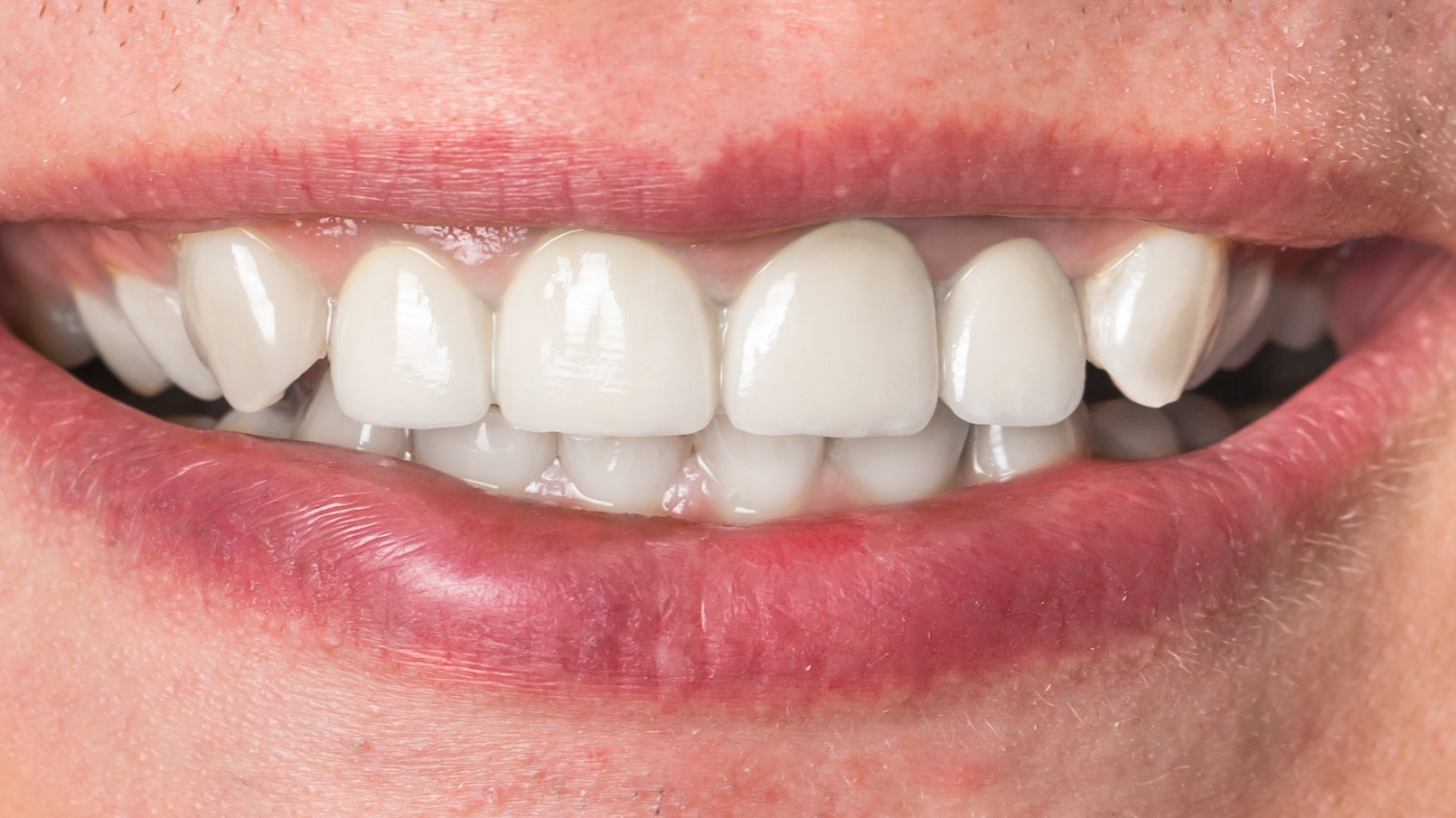 Dental Restoration Procedures