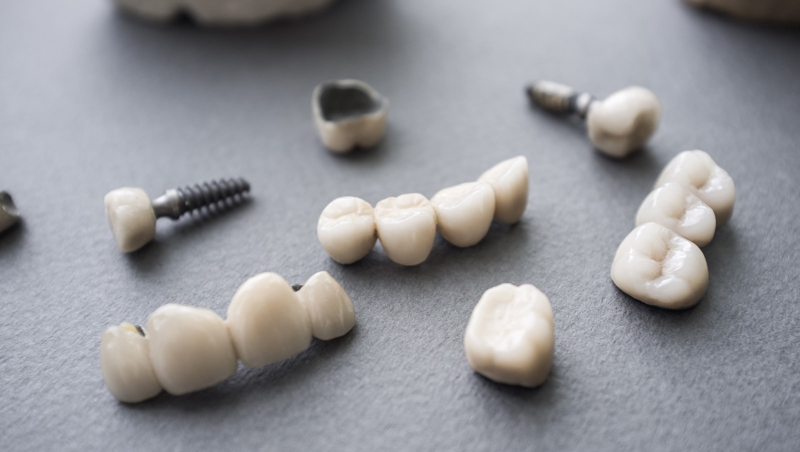 Differences Between Dental Crowns and Bridges