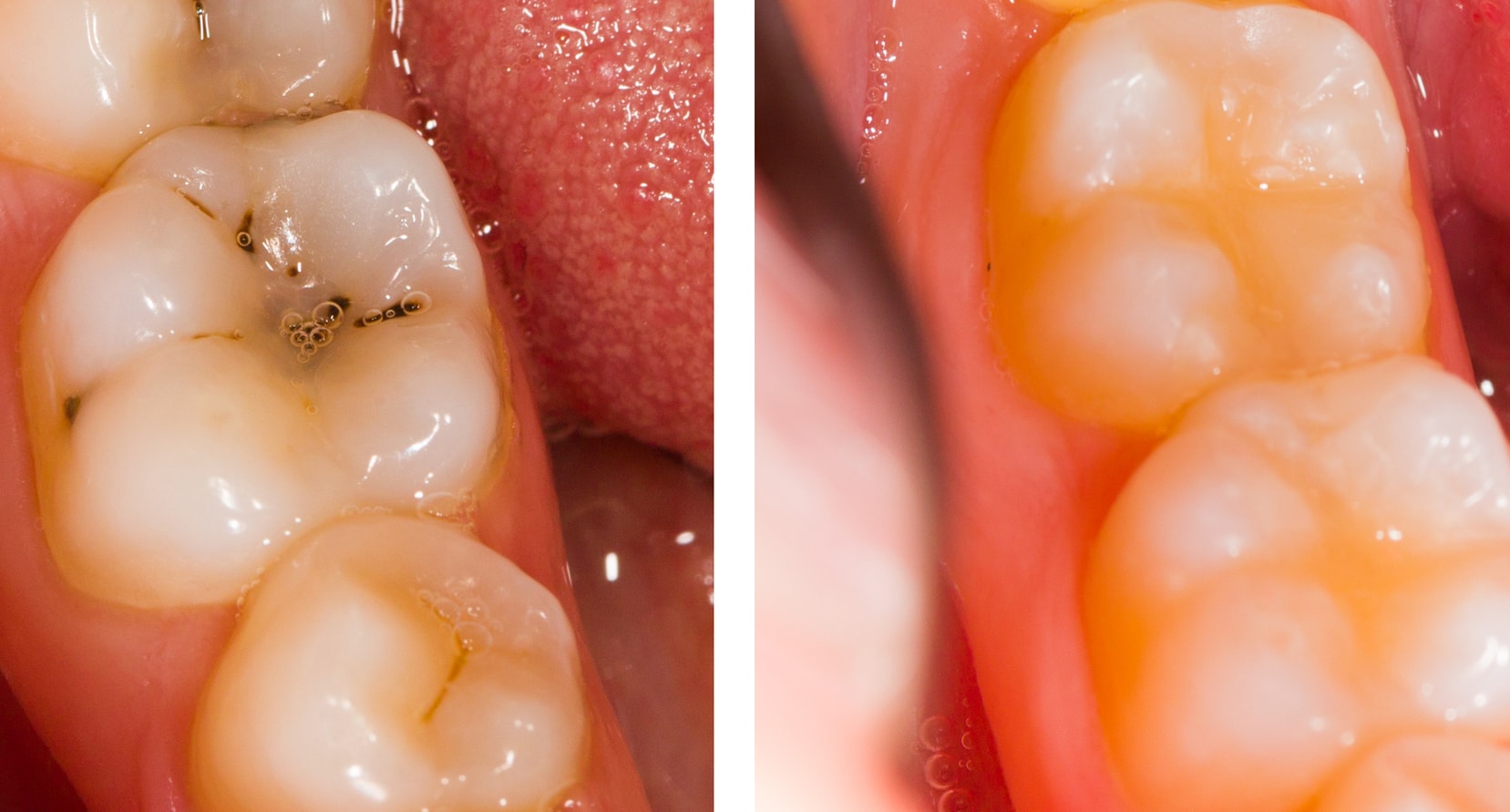 Direct Composite Dental Bonding