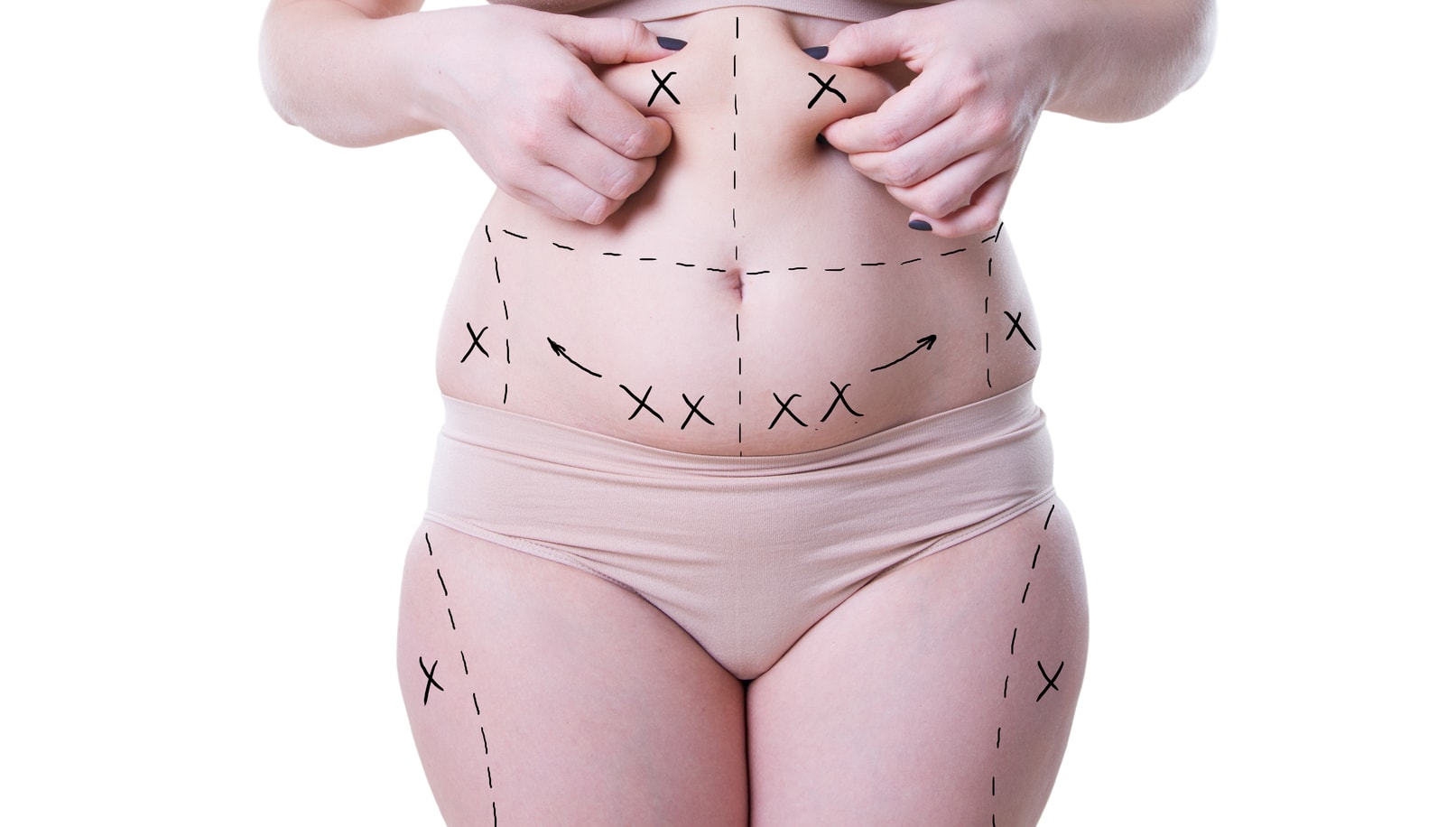 Mini Tummy Tuck: Is It Right for You? - Camille Cash, M.D.