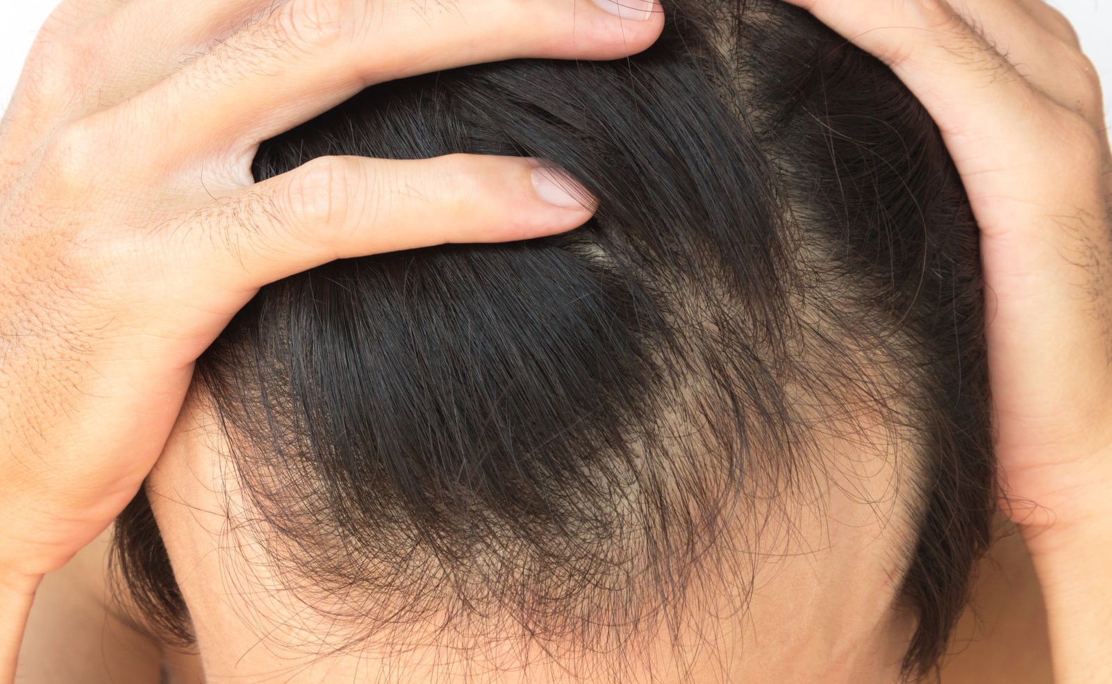 Hair Transplant Complications