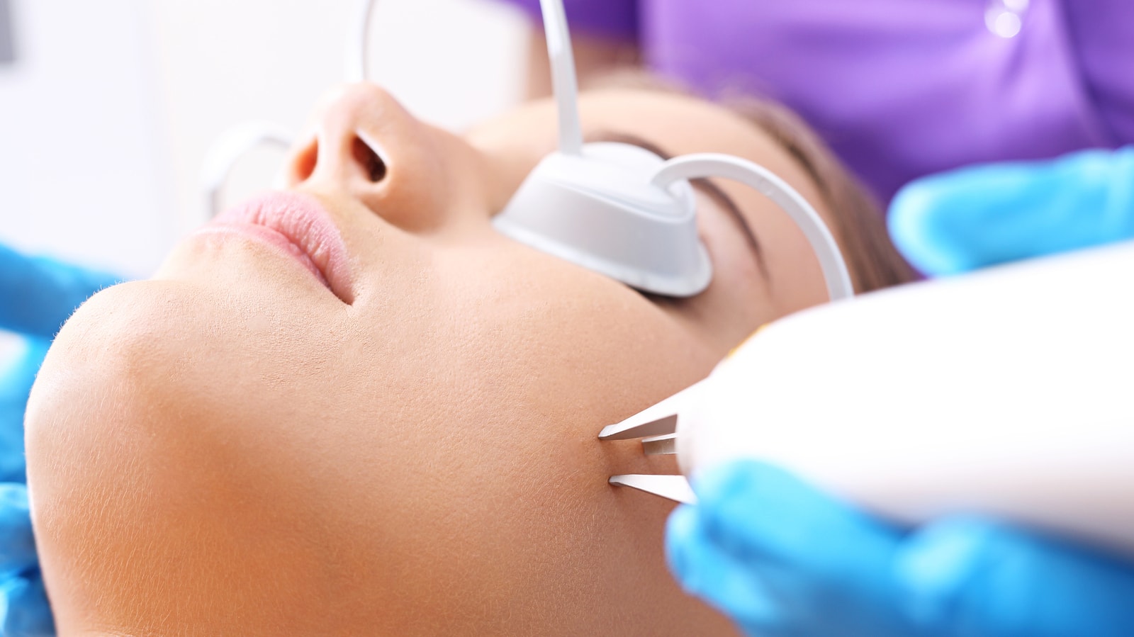 Laser Skin Resurfacing for Acne Scar Treatment