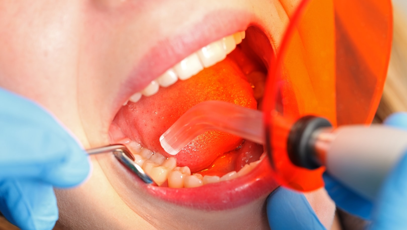 Latest Advancements in Dental Fillings