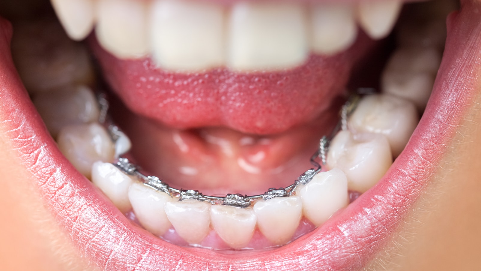 Лингвальные брекеты Incognito и Win: исправления прикуса зубов внутренними брекетами