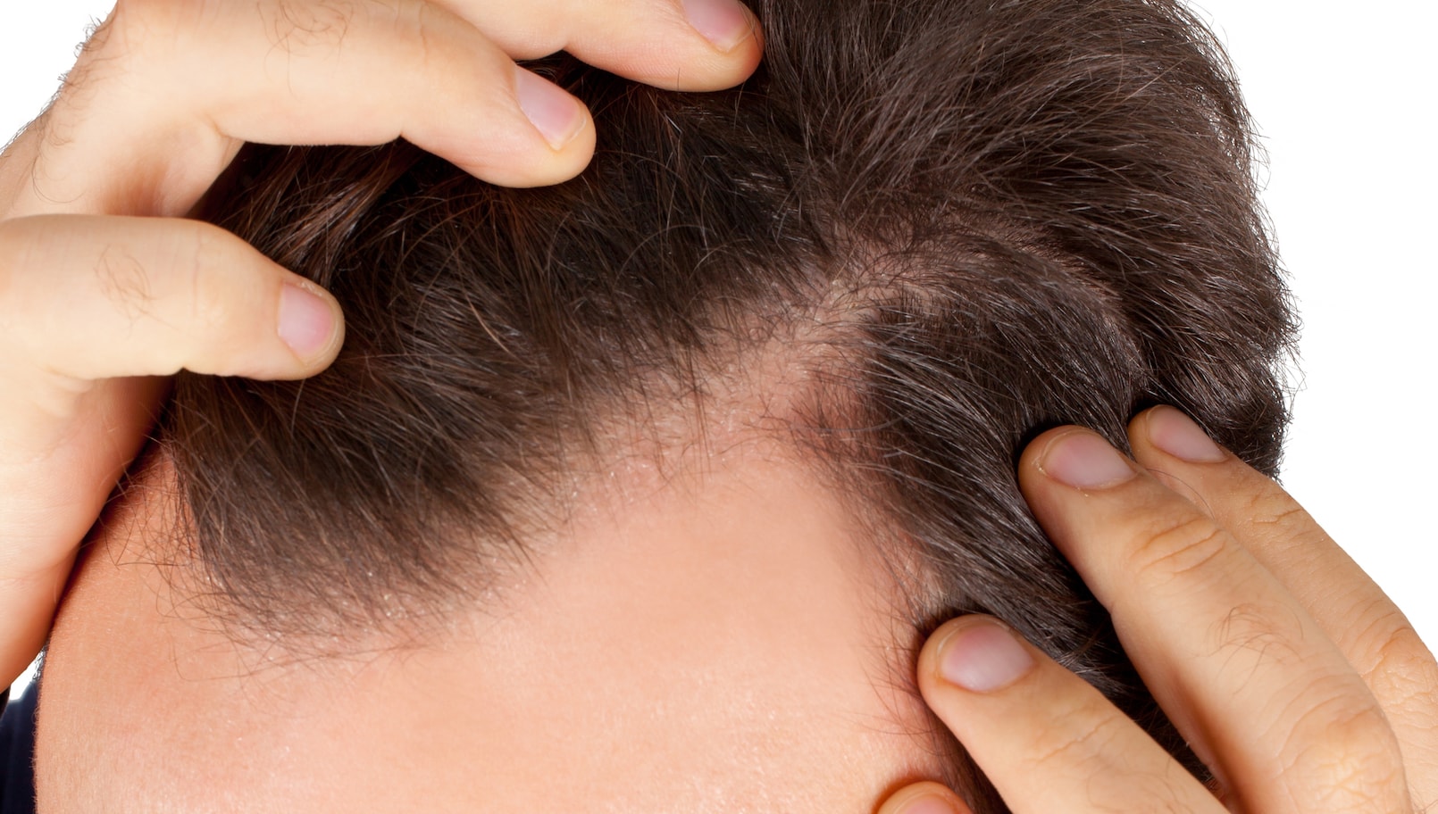 Manual FUE Hair Transplant