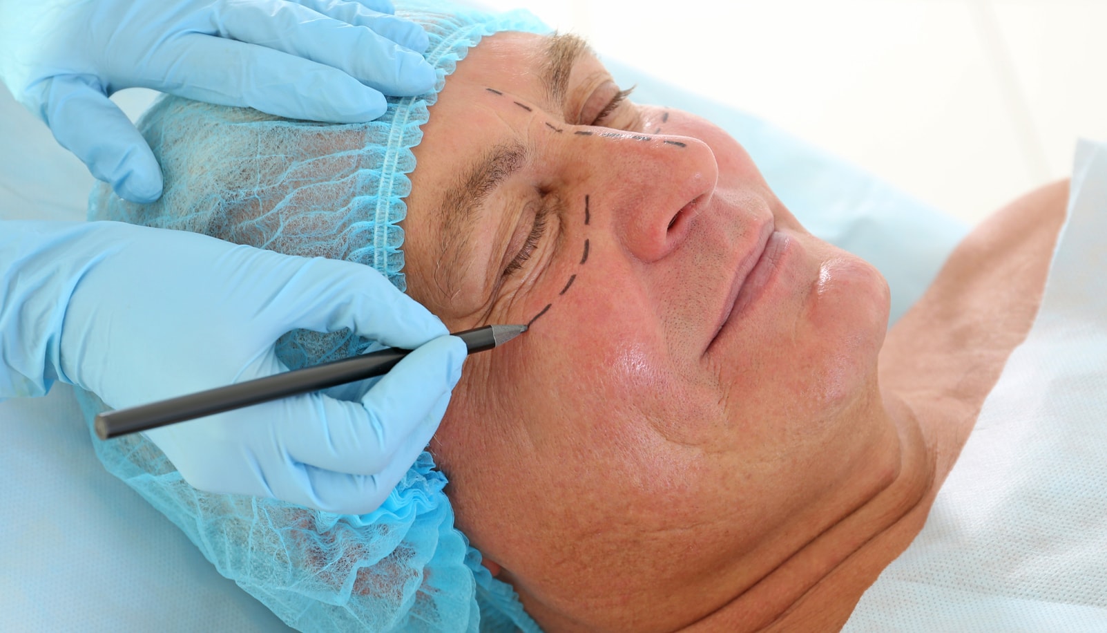 Skin Pinch Blepharoplasty