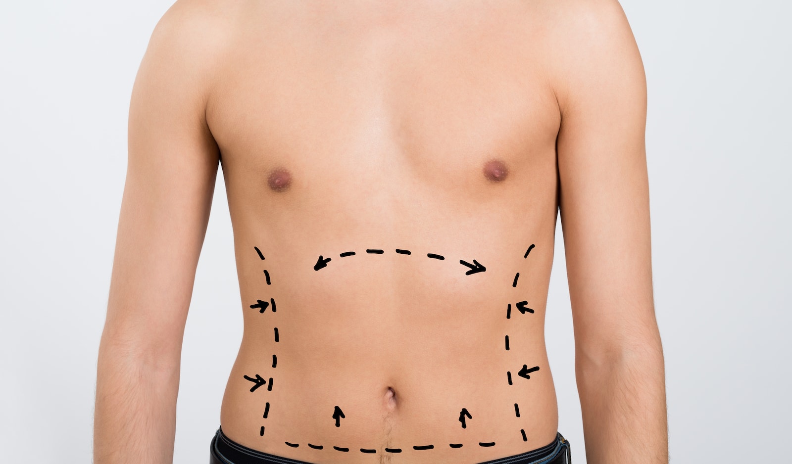 TRAM Flap Reconstruction