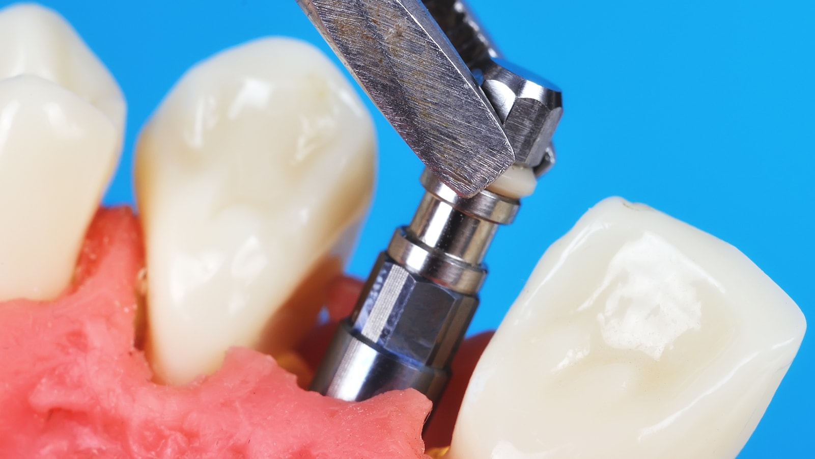 Titanium Dental Implants