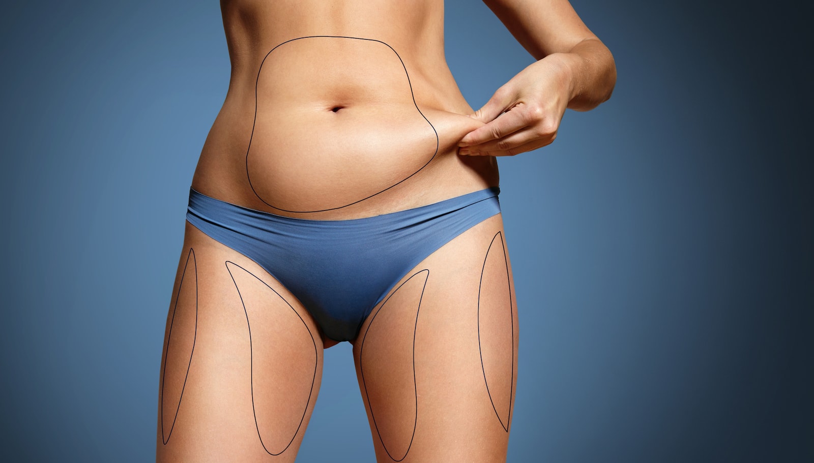 Tumescent Liposuction