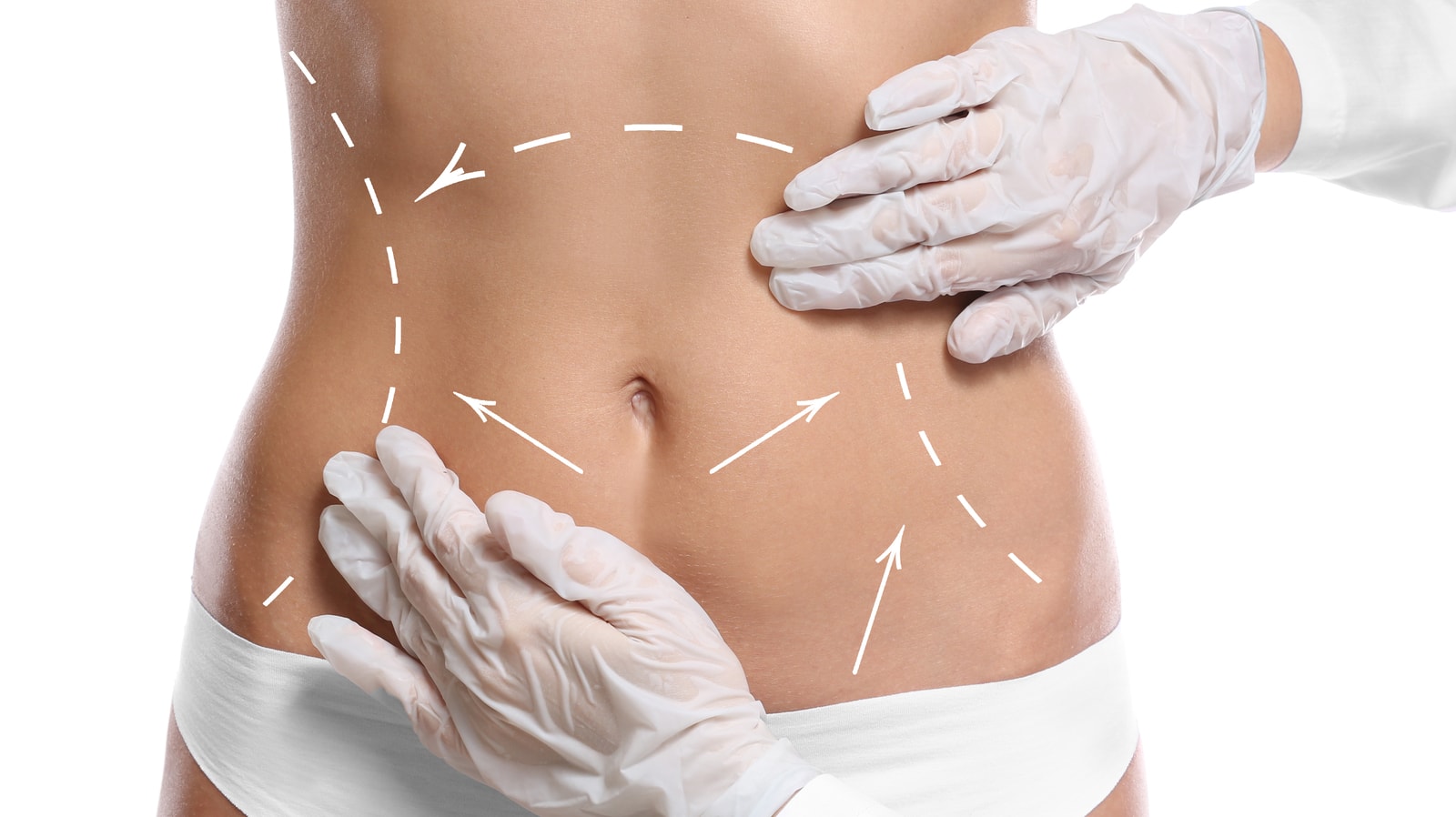 Tummy Tuck vs. Liposuction